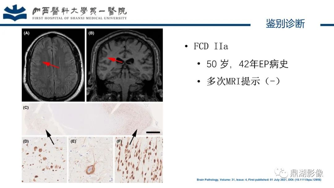 影像PPT - 【PPT】MOGHE的MRI诊断与鉴别诊断-29 影像PPT - 【PPT】MOGHE的MRI诊断与鉴别诊断-29