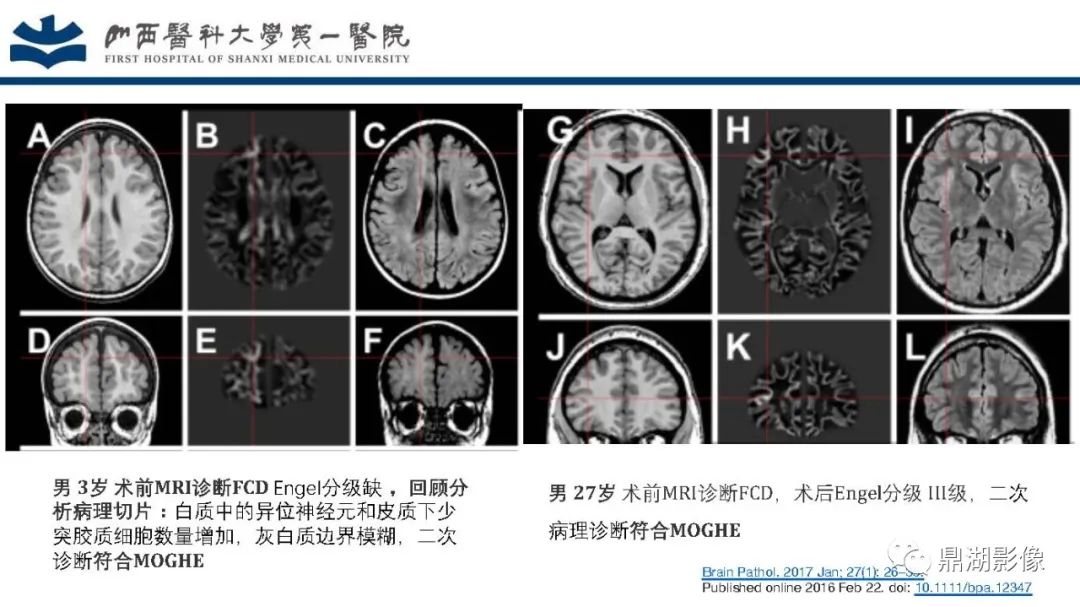 影像PPT - 【PPT】MOGHE的MRI诊断与鉴别诊断-20 影像PPT - 【PPT】MOGHE的MRI诊断与鉴别诊断-20