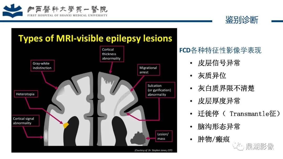 影像PPT - 【PPT】MOGHE的MRI诊断与鉴别诊断-24 影像PPT - 【PPT】MOGHE的MRI诊断与鉴别诊断-24