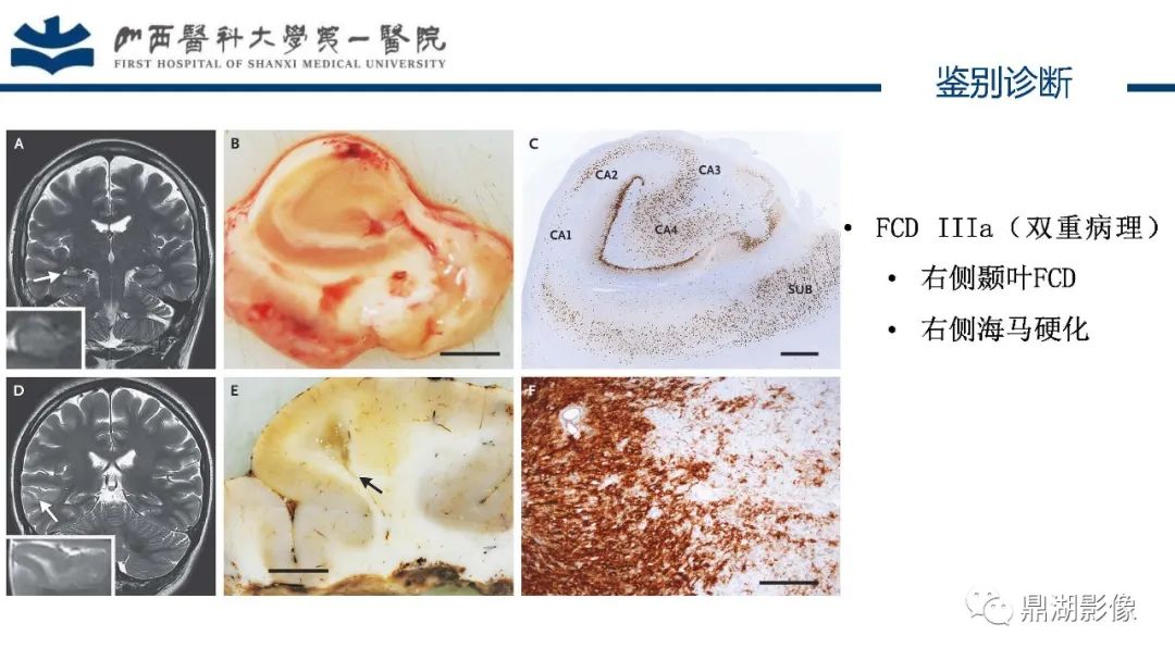 影像PPT - 【PPT】MOGHE的MRI诊断与鉴别诊断-36 影像PPT - 【PPT】MOGHE的MRI诊断与鉴别诊断-36