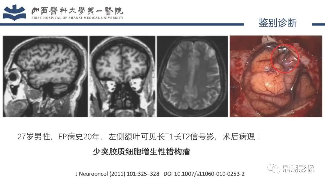 影像PPT - 【PPT】MOGHE的MRI诊断与鉴别诊断-35 影像PPT - 【PPT】MOGHE的MRI诊断与鉴别诊断-35
