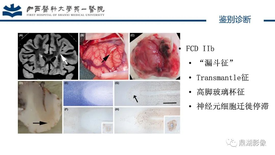 影像PPT - 【PPT】MOGHE的MRI诊断与鉴别诊断-31 影像PPT - 【PPT】MOGHE的MRI诊断与鉴别诊断-31