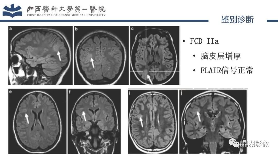 影像PPT - 【PPT】MOGHE的MRI诊断与鉴别诊断-30 影像PPT - 【PPT】MOGHE的MRI诊断与鉴别诊断-30