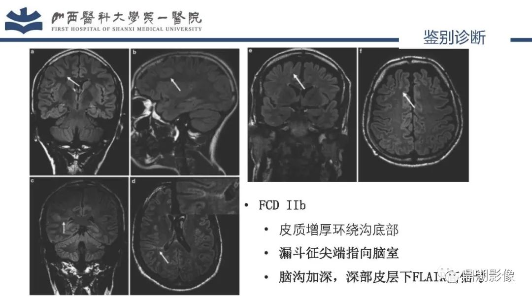 影像PPT - 【PPT】MOGHE的MRI诊断与鉴别诊断-33 影像PPT - 【PPT】MOGHE的MRI诊断与鉴别诊断-33