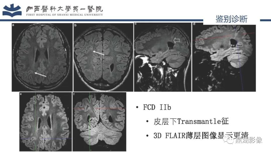 影像PPT - 【PPT】MOGHE的MRI诊断与鉴别诊断-32 影像PPT - 【PPT】MOGHE的MRI诊断与鉴别诊断-32