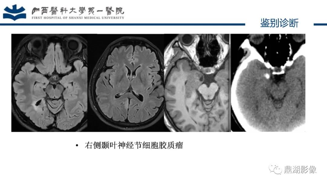 影像PPT - 【PPT】MOGHE的MRI诊断与鉴别诊断-37 影像PPT - 【PPT】MOGHE的MRI诊断与鉴别诊断-37
