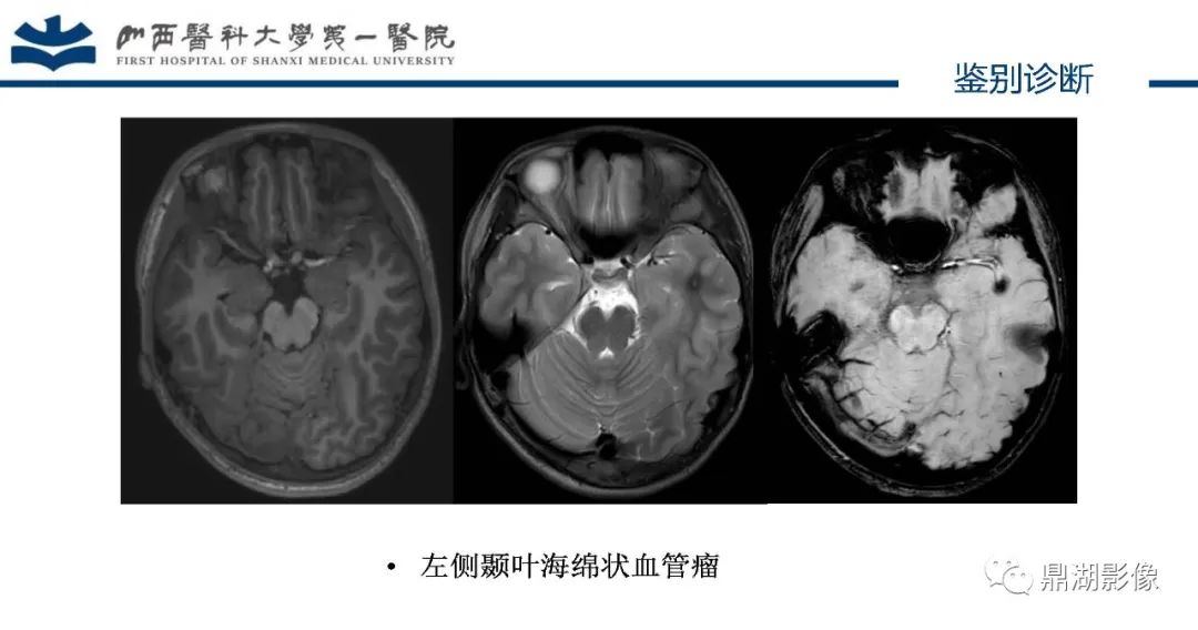 影像PPT - 【PPT】MOGHE的MRI诊断与鉴别诊断-39 影像PPT - 【PPT】MOGHE的MRI诊断与鉴别诊断-39