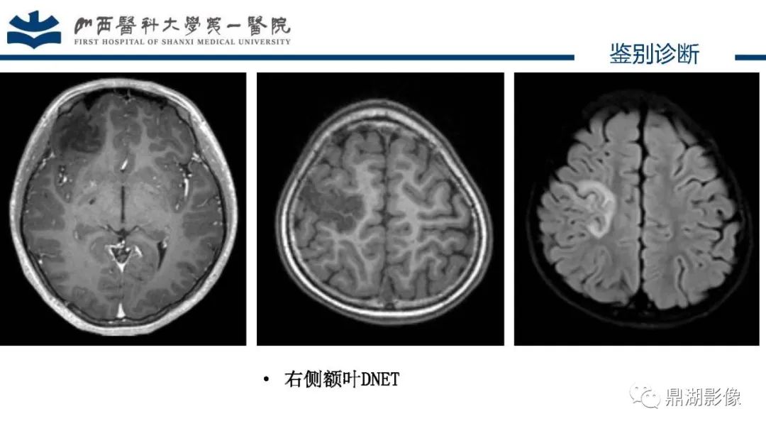 影像PPT - 【PPT】MOGHE的MRI诊断与鉴别诊断-38 影像PPT - 【PPT】MOGHE的MRI诊断与鉴别诊断-38