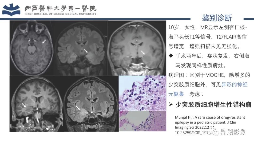 影像PPT - 【PPT】MOGHE的MRI诊断与鉴别诊断-34 影像PPT - 【PPT】MOGHE的MRI诊断与鉴别诊断-34