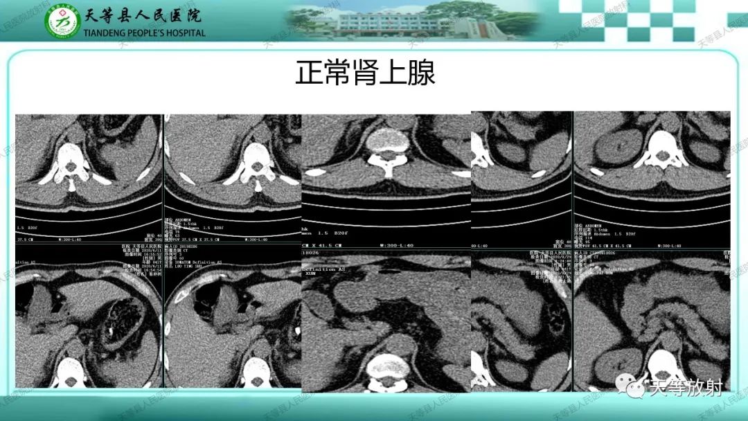 影像PPT - 【PPT】肾上腺常见肿瘤的CT诊断-4