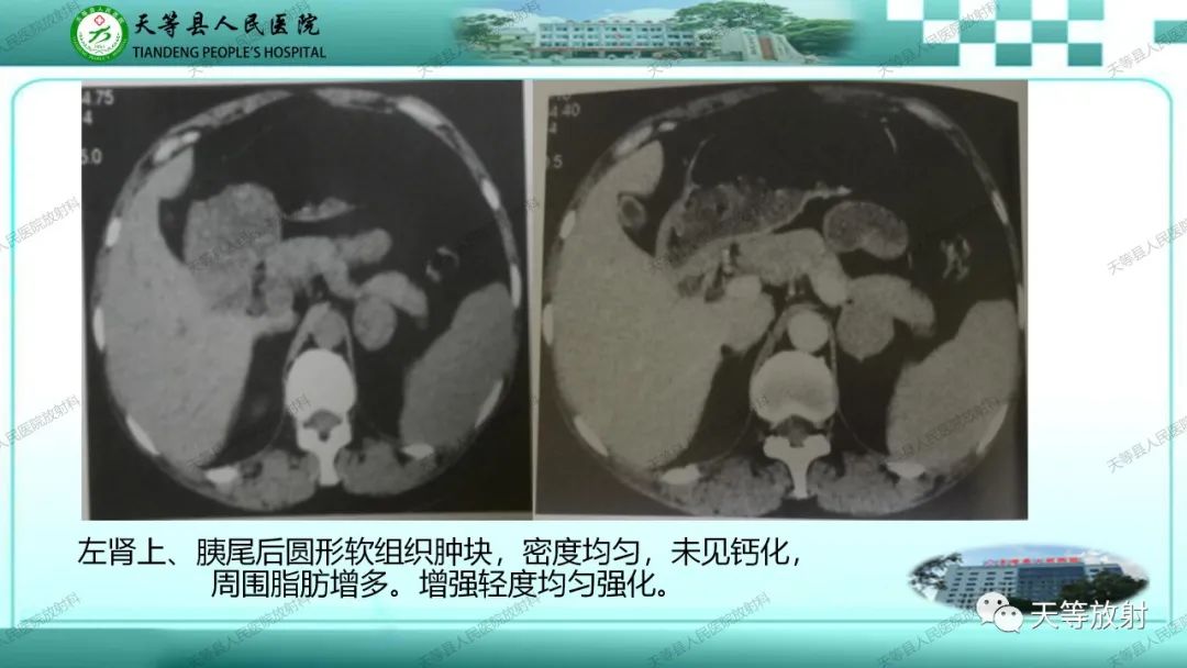 影像PPT - 【PPT】肾上腺常见肿瘤的CT诊断-9
