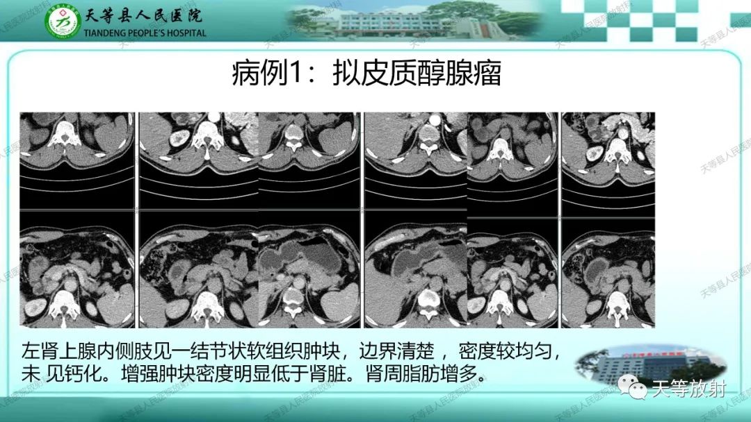 影像PPT - 【PPT】肾上腺常见肿瘤的CT诊断-7