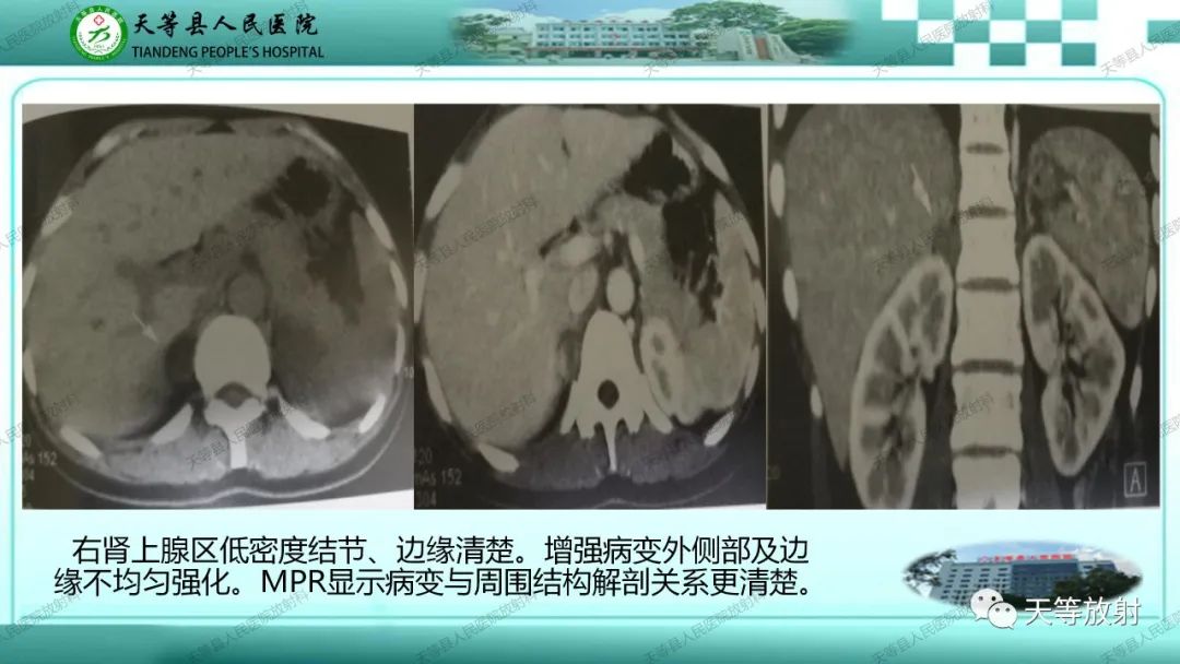 影像PPT - 【PPT】肾上腺常见肿瘤的CT诊断-11