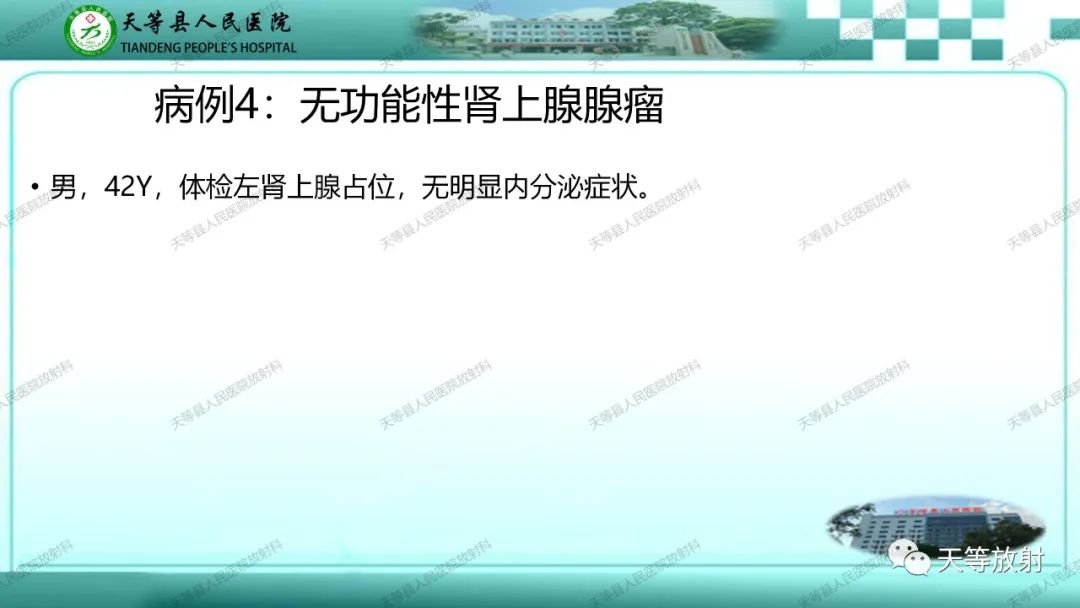 影像PPT - 【PPT】肾上腺常见肿瘤的CT诊断-12