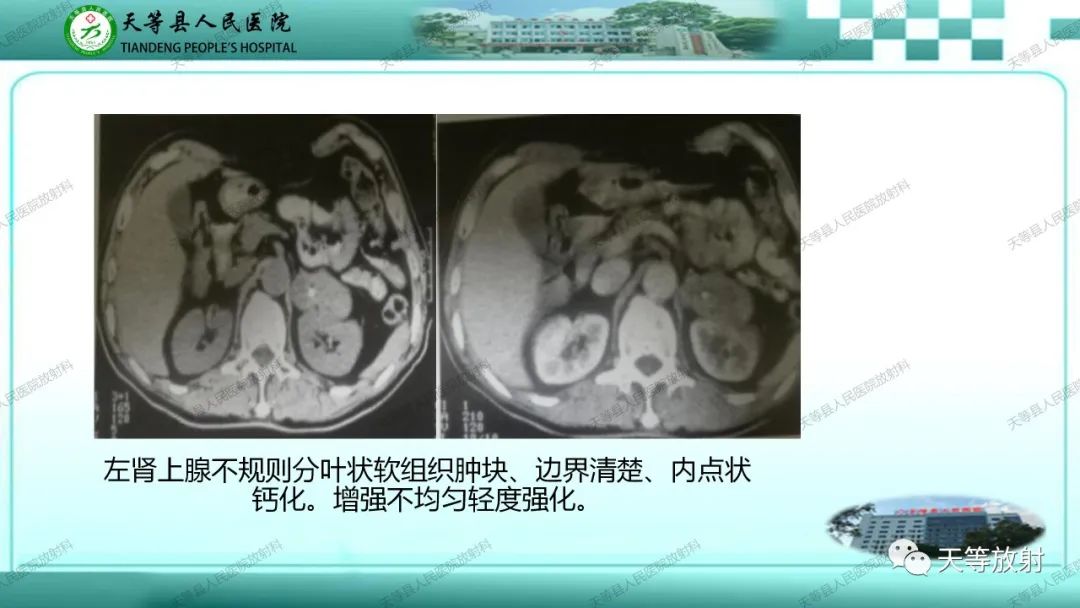 影像PPT - 【PPT】肾上腺常见肿瘤的CT诊断-13