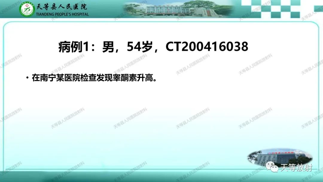 影像PPT - 【PPT】肾上腺常见肿瘤的CT诊断-6