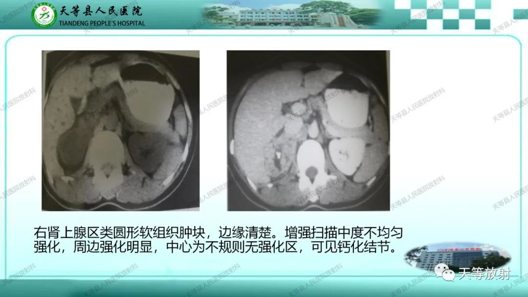 影像PPT - 【PPT】肾上腺常见肿瘤的CT诊断-15