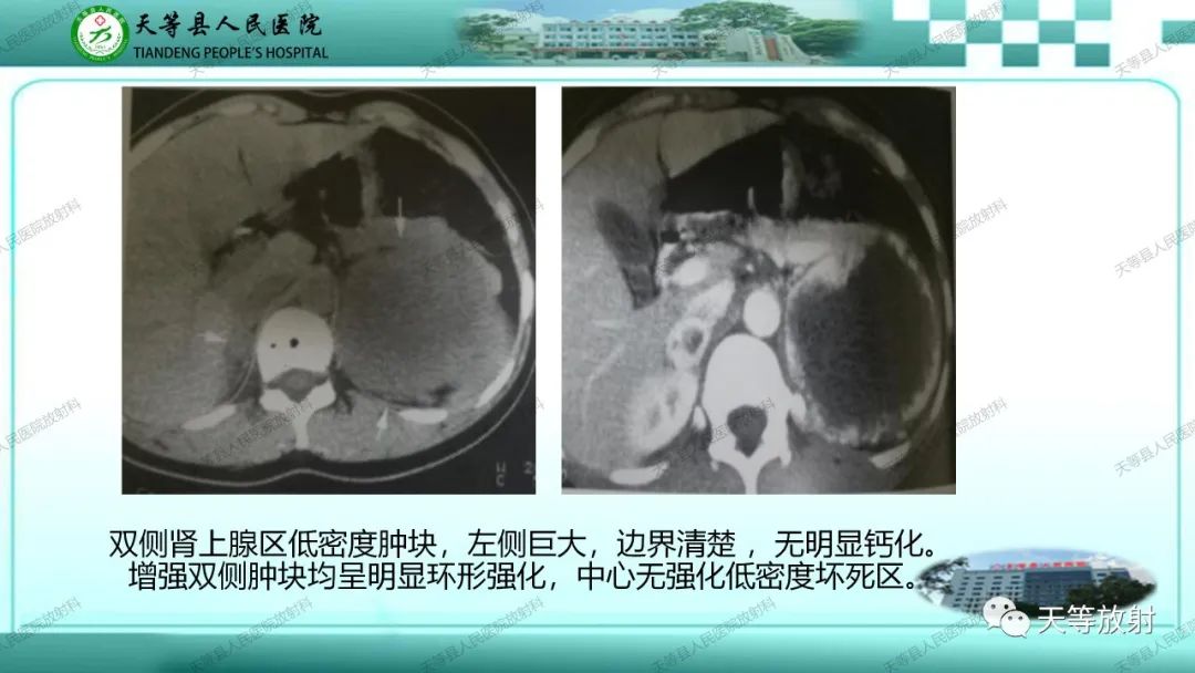影像PPT - 【PPT】肾上腺常见肿瘤的CT诊断-17