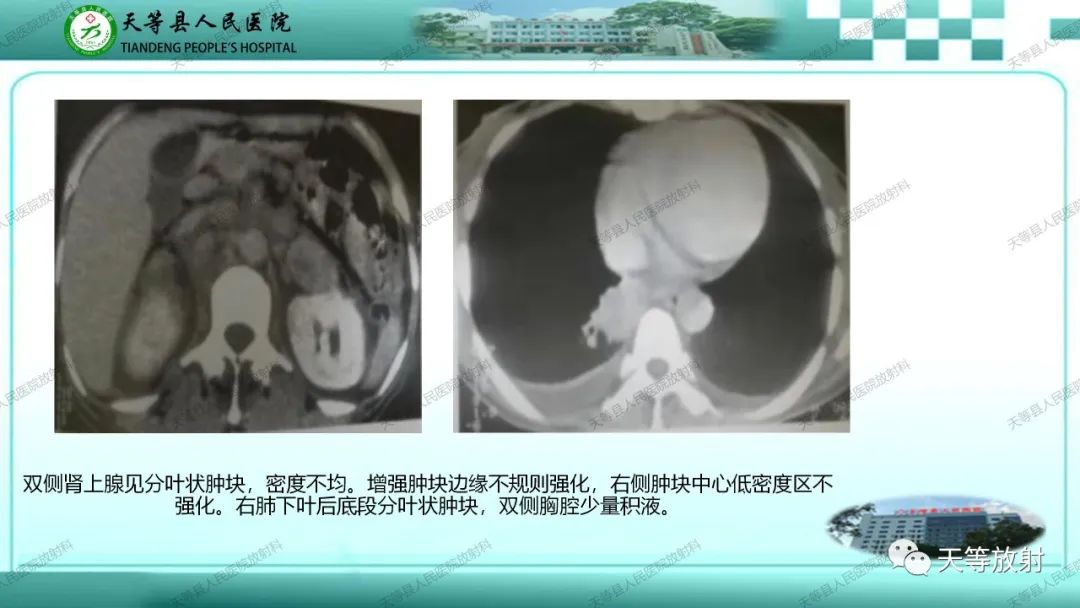 影像PPT - 【PPT】肾上腺常见肿瘤的CT诊断-19