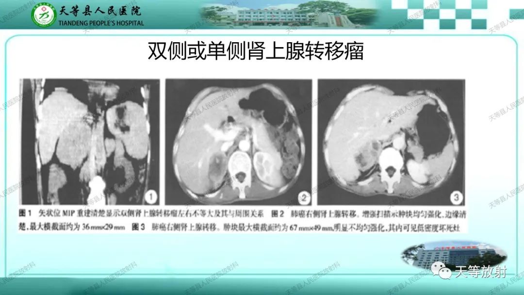 影像PPT - 【PPT】肾上腺常见肿瘤的CT诊断-20