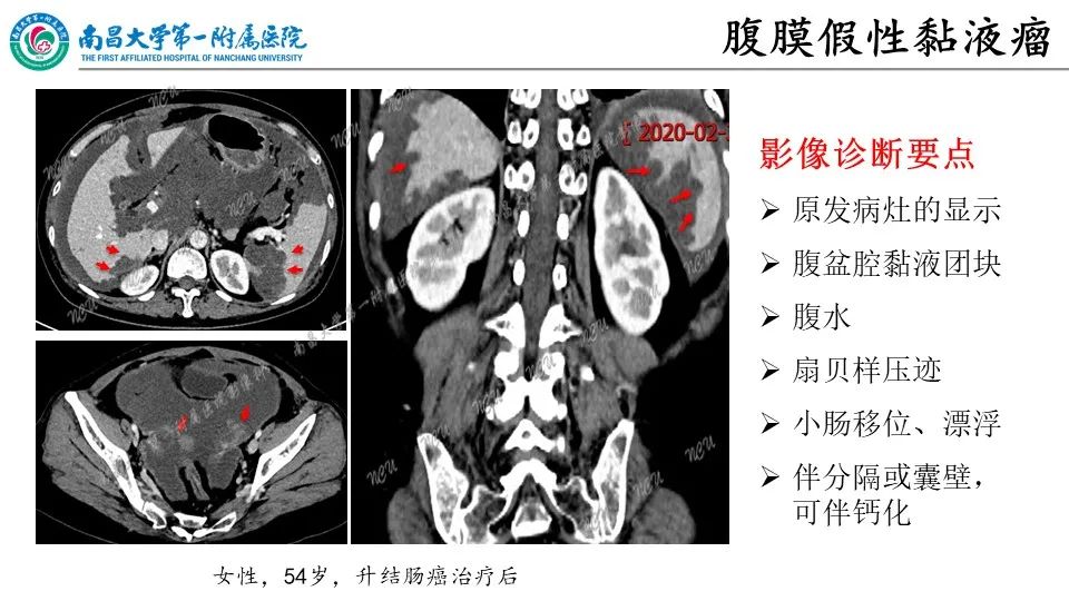 影像PPT - 【PPT】腹膜解剖及常见疾病的影像诊断-14