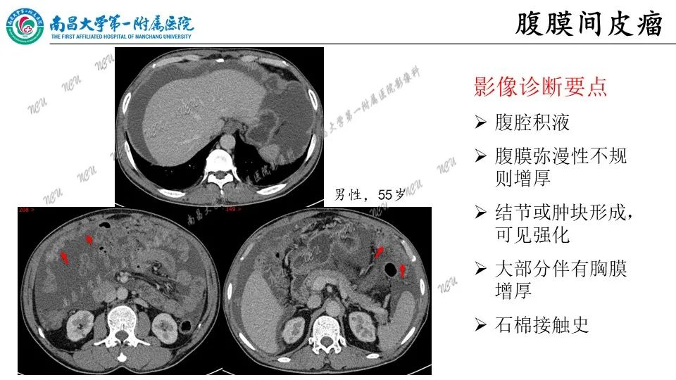 影像PPT - 【PPT】腹膜解剖及常见疾病的影像诊断-17