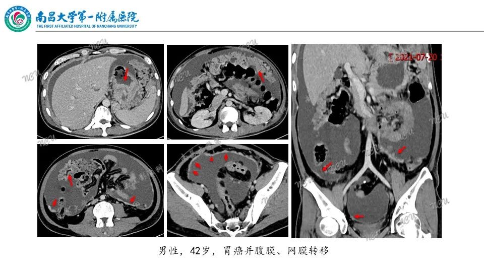影像PPT - 【PPT】腹膜解剖及常见疾病的影像诊断-20