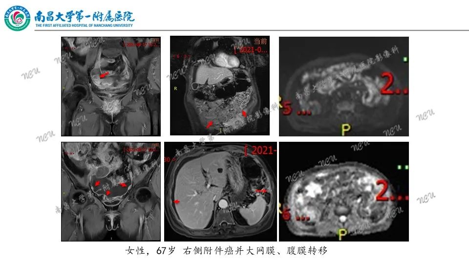 影像PPT - 【PPT】腹膜解剖及常见疾病的影像诊断-21