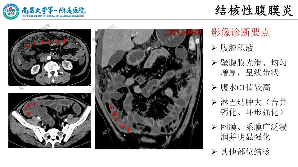 影像PPT - 【PPT】腹膜解剖及常见疾病的影像诊断-24