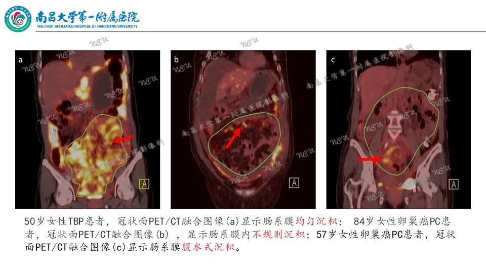 影像PPT - 【PPT】腹膜解剖及常见疾病的影像诊断-25