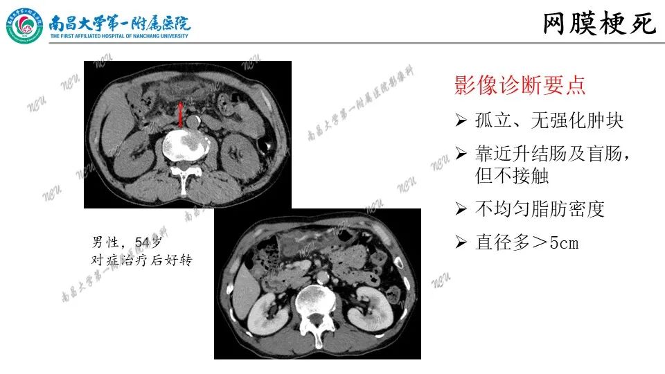 影像PPT - 【PPT】腹膜解剖及常见疾病的影像诊断-28