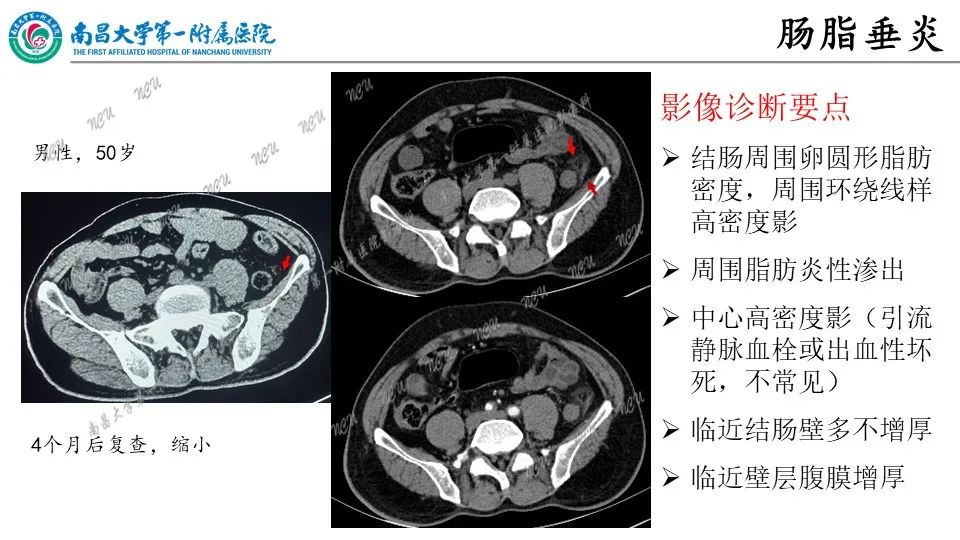 影像PPT - 【PPT】腹膜解剖及常见疾病的影像诊断-27