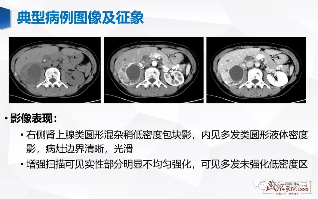 影像PPT - 【病例】肾上腺嗜铬细胞瘤 腹膜后淋巴瘤-4