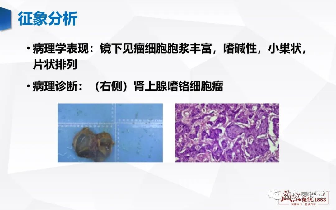 影像PPT - 【病例】肾上腺嗜铬细胞瘤 腹膜后淋巴瘤-6