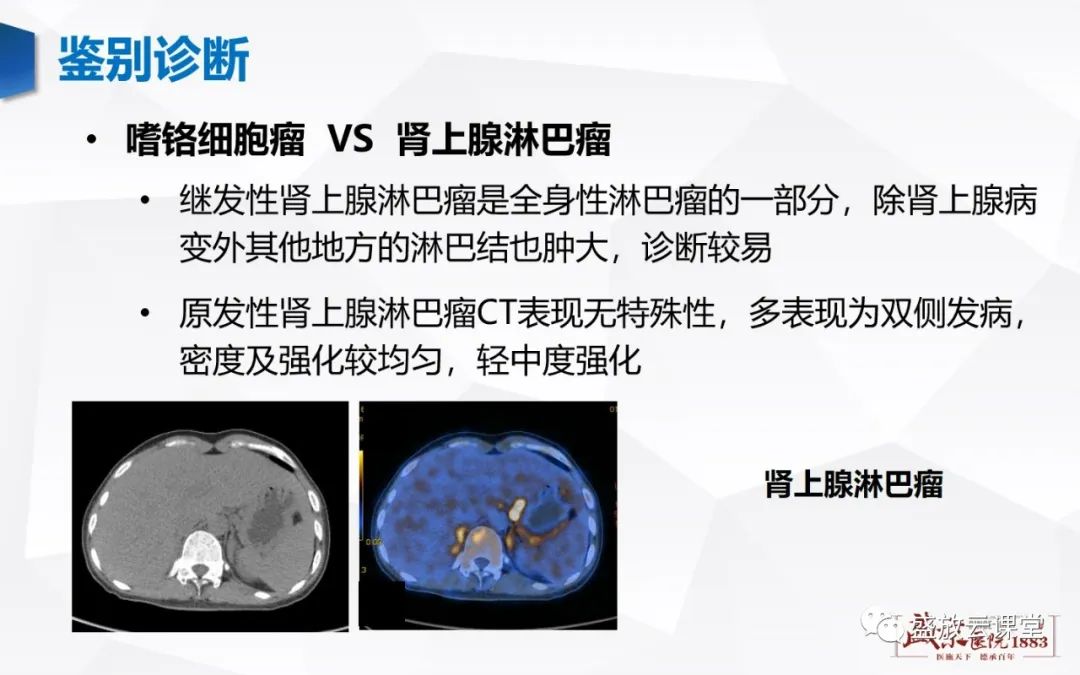 影像PPT - 【病例】肾上腺嗜铬细胞瘤 腹膜后淋巴瘤-12