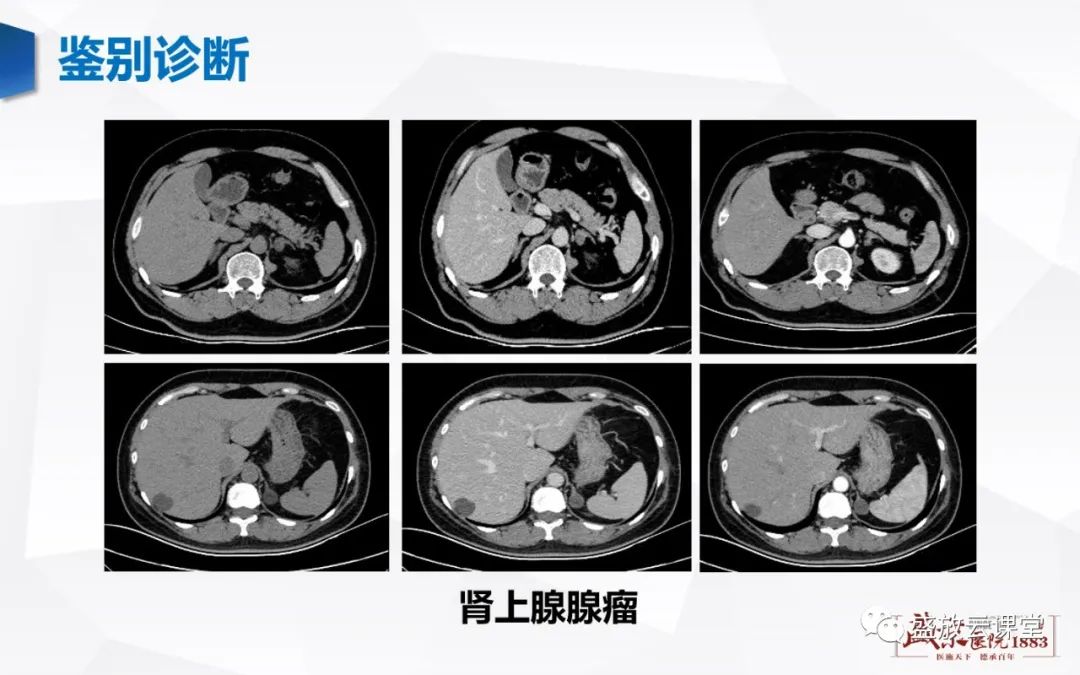 影像PPT - 【病例】肾上腺嗜铬细胞瘤 腹膜后淋巴瘤-14