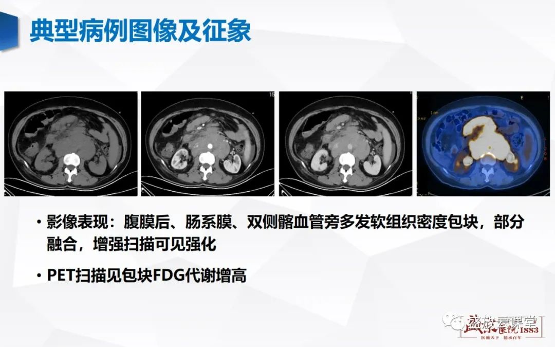 影像PPT - 【病例】肾上腺嗜铬细胞瘤 腹膜后淋巴瘤-22