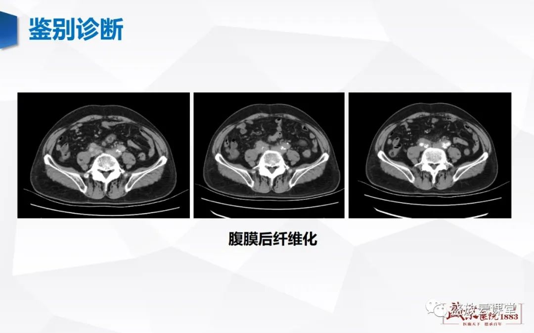 影像PPT - 【病例】肾上腺嗜铬细胞瘤 腹膜后淋巴瘤-30