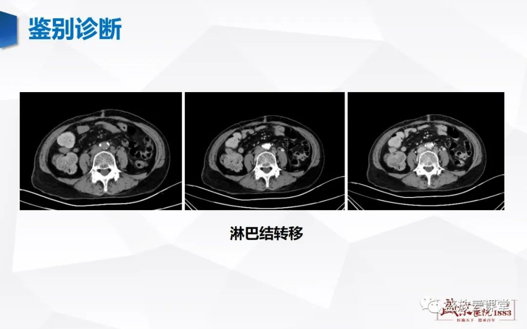 影像PPT - 【病例】肾上腺嗜铬细胞瘤 腹膜后淋巴瘤-32
