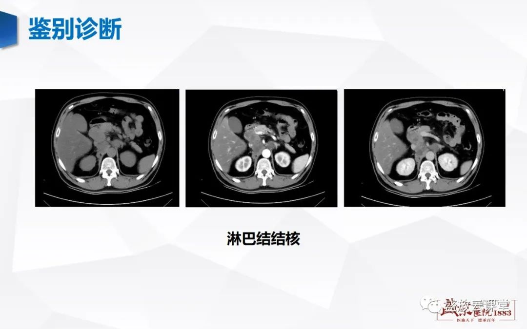 影像PPT - 【病例】肾上腺嗜铬细胞瘤 腹膜后淋巴瘤-28