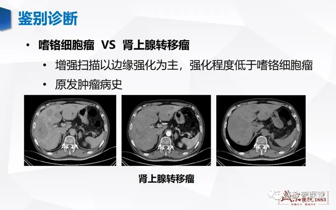 影像PPT - 【病例】肾上腺嗜铬细胞瘤 腹膜后淋巴瘤-11