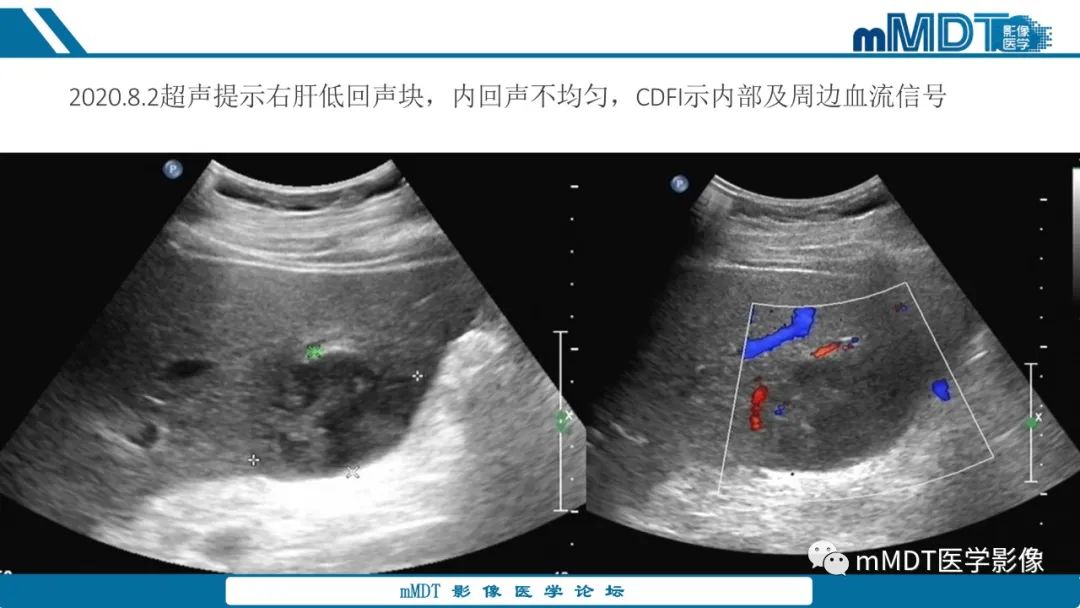 影像PPT - 【PPT】肝炎性肌纤维母细胞瘤-3 影像PPT - 【PPT】肝炎性肌纤维母细胞瘤-3