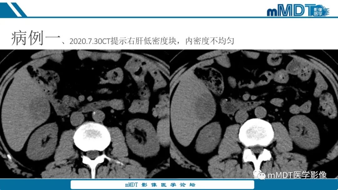 影像PPT - 【PPT】肝炎性肌纤维母细胞瘤-2 影像PPT - 【PPT】肝炎性肌纤维母细胞瘤-2