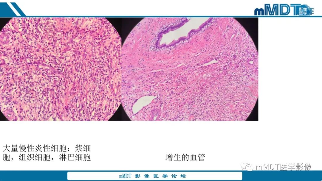 影像PPT - 【PPT】肝炎性肌纤维母细胞瘤-12 影像PPT - 【PPT】肝炎性肌纤维母细胞瘤-12