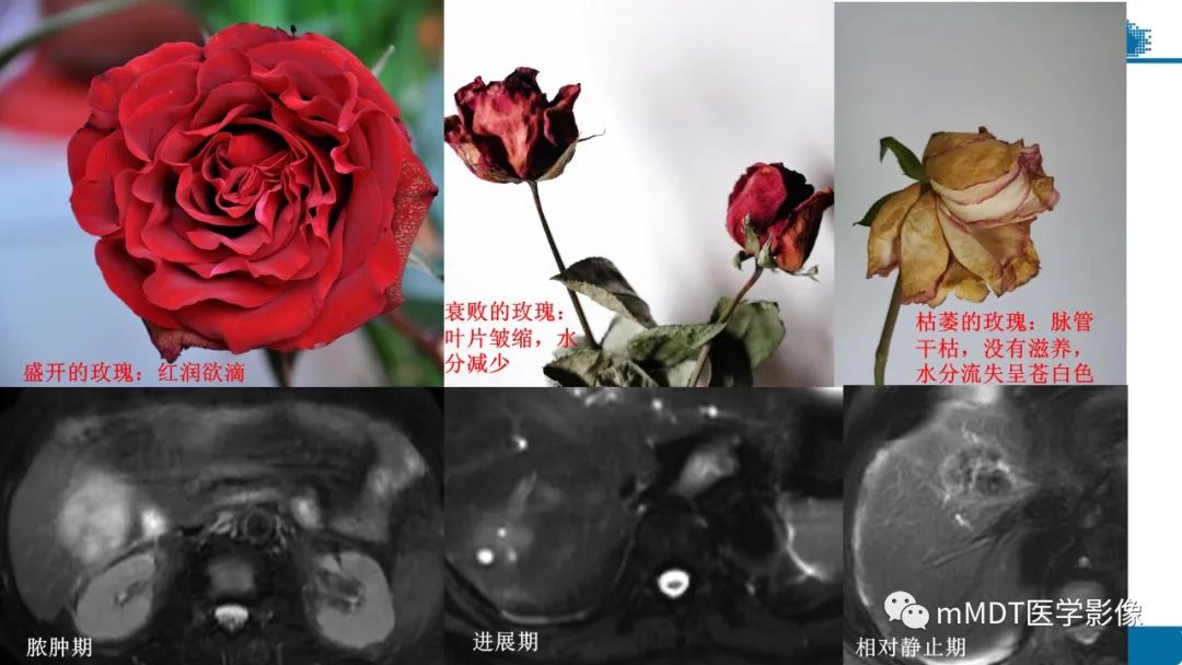 影像PPT - 【PPT】肝炎性肌纤维母细胞瘤-15 影像PPT - 【PPT】肝炎性肌纤维母细胞瘤-15