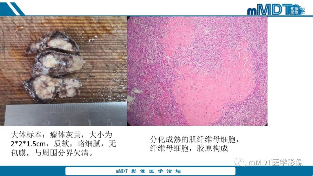 影像PPT - 【PPT】肝炎性肌纤维母细胞瘤-11 影像PPT - 【PPT】肝炎性肌纤维母细胞瘤-11