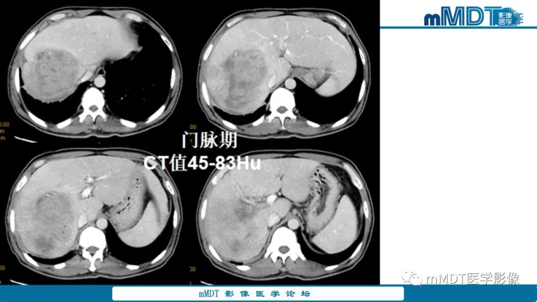 影像PPT - 【PPT】肝炎性肌纤维母细胞瘤-22 影像PPT - 【PPT】肝炎性肌纤维母细胞瘤-22