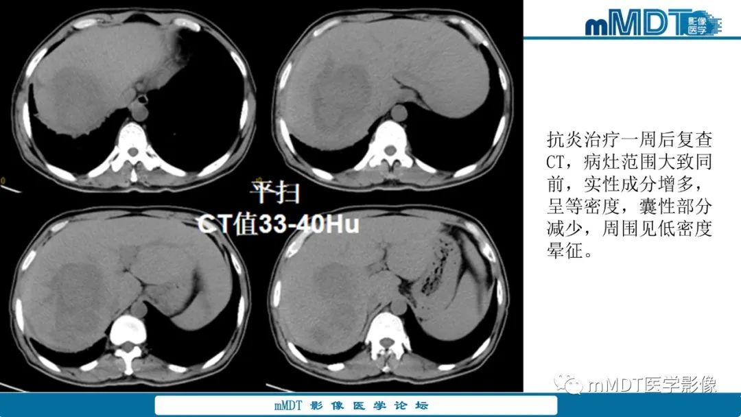 影像PPT - 【PPT】肝炎性肌纤维母细胞瘤-20 影像PPT - 【PPT】肝炎性肌纤维母细胞瘤-20