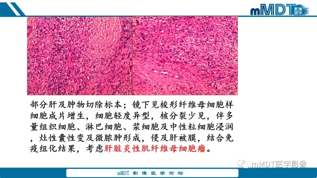 影像PPT - 【PPT】肝炎性肌纤维母细胞瘤-24 影像PPT - 【PPT】肝炎性肌纤维母细胞瘤-24