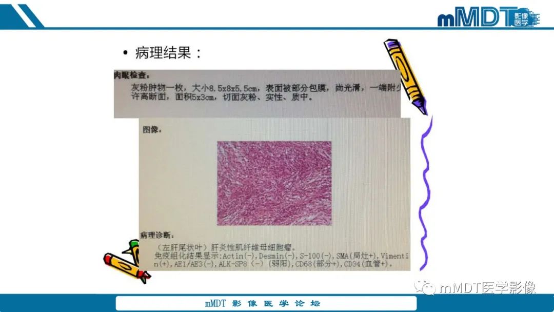 影像PPT - 【PPT】肝炎性肌纤维母细胞瘤-30 影像PPT - 【PPT】肝炎性肌纤维母细胞瘤-30